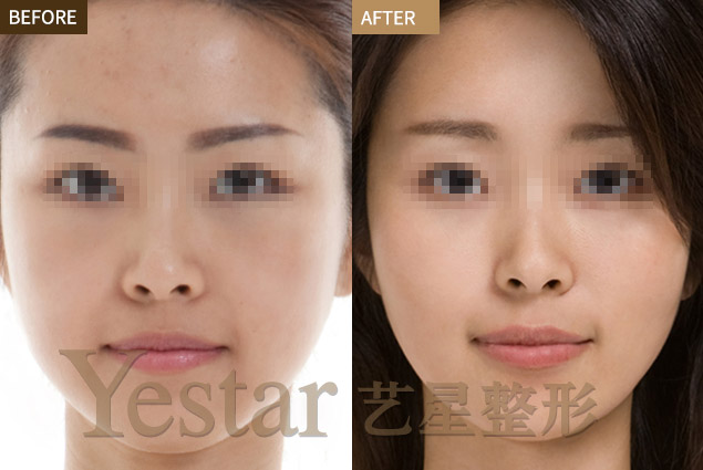 opt能美白祛斑做一次大概需要多少钱-谁用过o