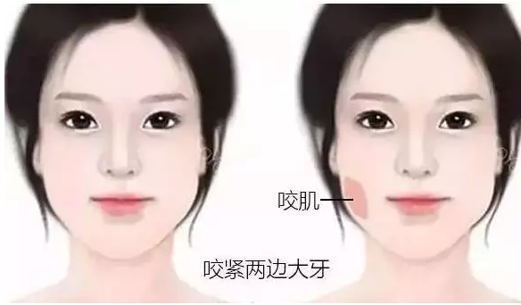 长沙整形注射瘦脸针能维持多久呢？