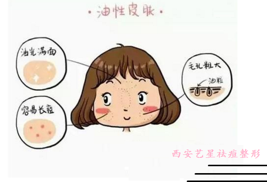 长沙艺星激光祛痘有哪些优势呢?