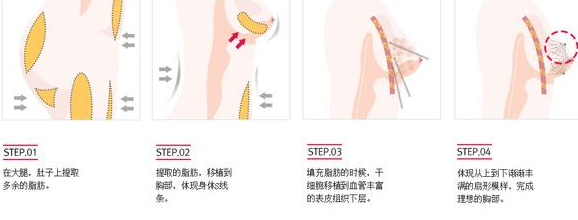 整形医院做自体脂肪隆胸手术吗?