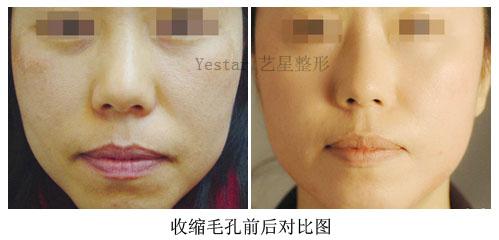非手术美容前后对比照