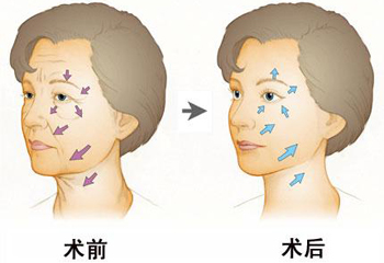 长沙复合除皱的作用怎样样呢？