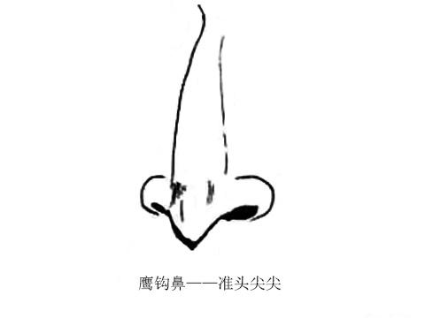 长沙鹰钩鼻的治疗方法有哪些呢？