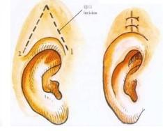 外耳再造