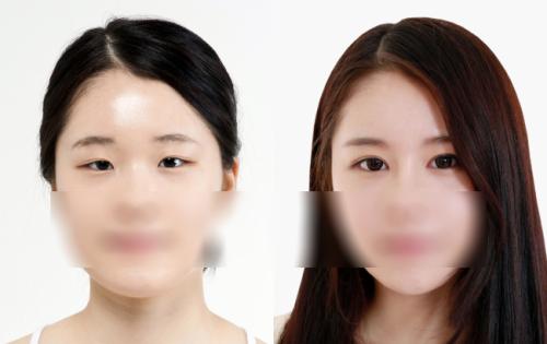 开眼角手术效果好吗