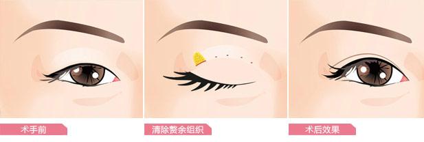 长沙上睑下垂的原因