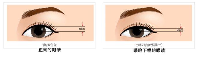 长沙上睑下垂的价格是多少