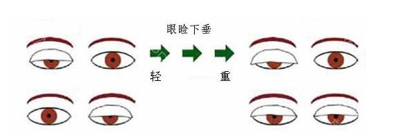 长沙上睑下垂矫正医院哪里好