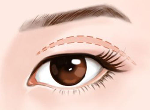 长沙眼睑下垂术后的护理事项